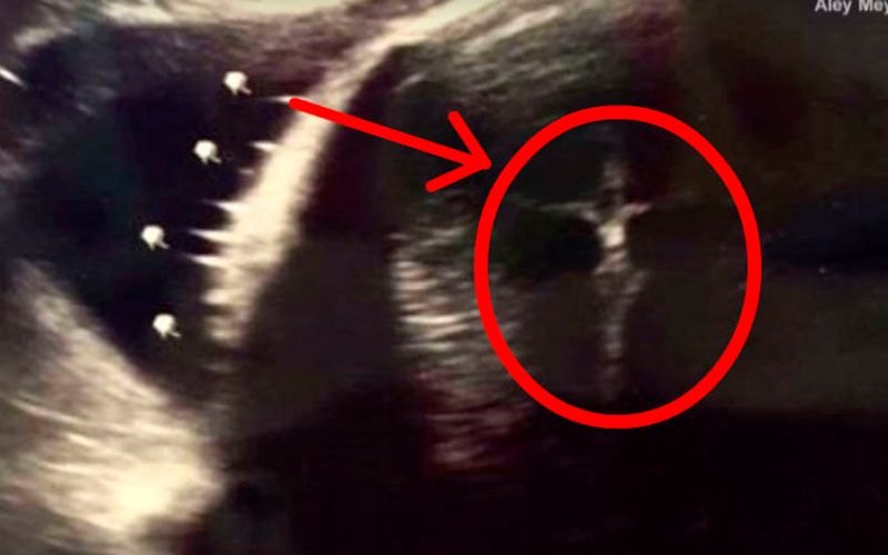 ¿Apareció un crucifijo en la ecografía de una mujer embarazada?