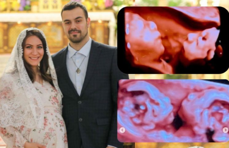 El testimonio de una madre católica embarazada de gemelos unidos por el mismo corazón